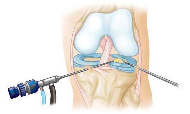 At the final stage of development, arthrosis is treated surgically