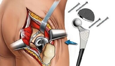 Endoprostetics for hip arthrosis