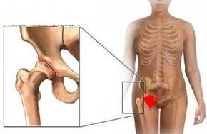 Reasons for the development of arthrosis of hip combination