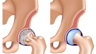 Symptoms of the arthrosis of hip combination
