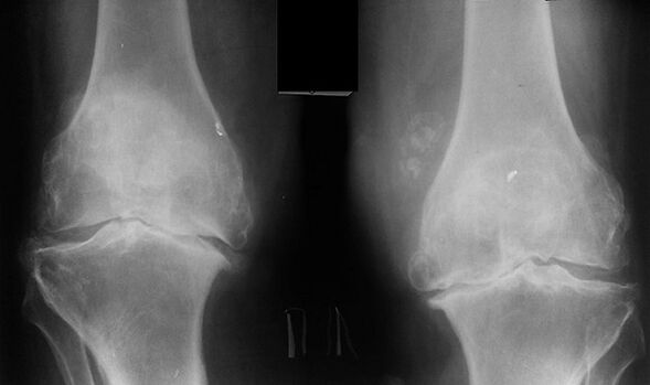 As a way of diagnosis of artrosis of x-knee joint