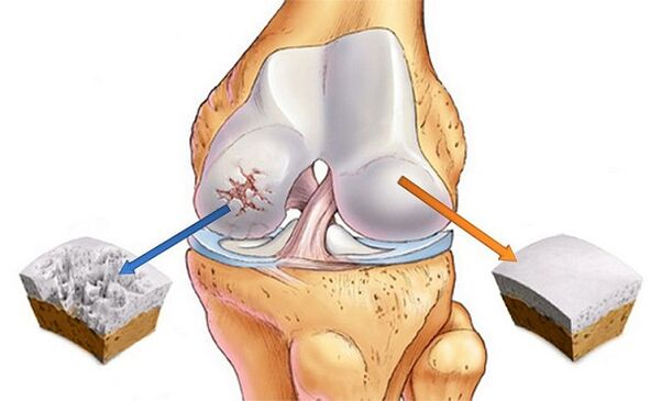Norma and deviations for arthrosis of knee joint