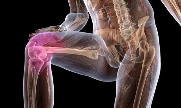 Signs and symptoms of artrosis of knee joint