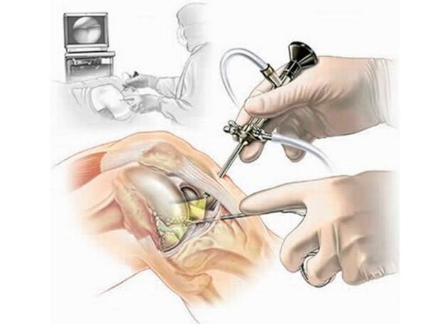 Arthroscopy of knee joint