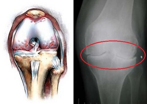Deformation of knee joint for arthros