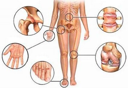 The arthritis and arthrobe of various joints