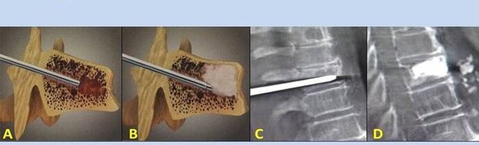 spinal puncture for back pain