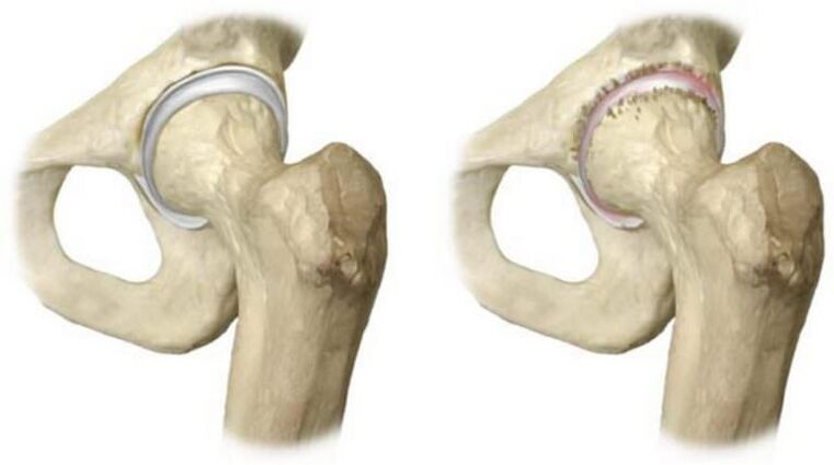 healthy hip joint and necrosis of the head as a cause of pain