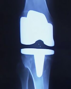 Radiograph of the knee with an artificial prosthesis after joint replacement surgery