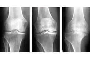 stages of osteoarthritis of the joint on X-ray