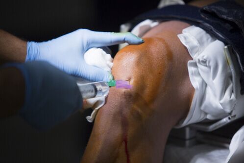 Injections in the knee joint for osteoarthritis